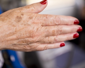 manchas-senis-nas-maos-maos-com-manchas-300x240